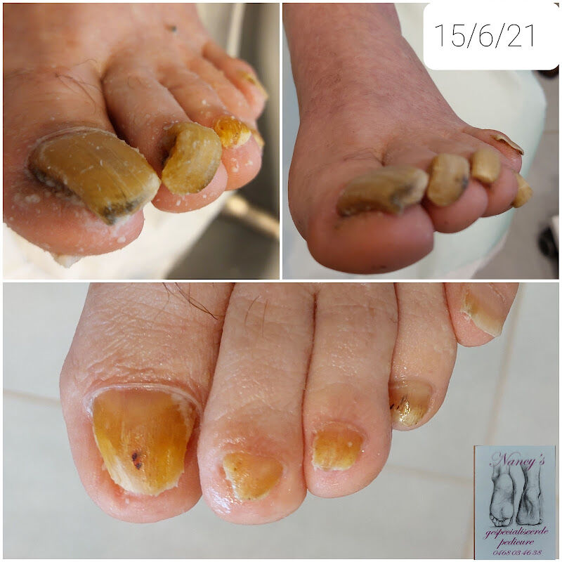 Foto van Nancy's gespecialiseerde pedicure