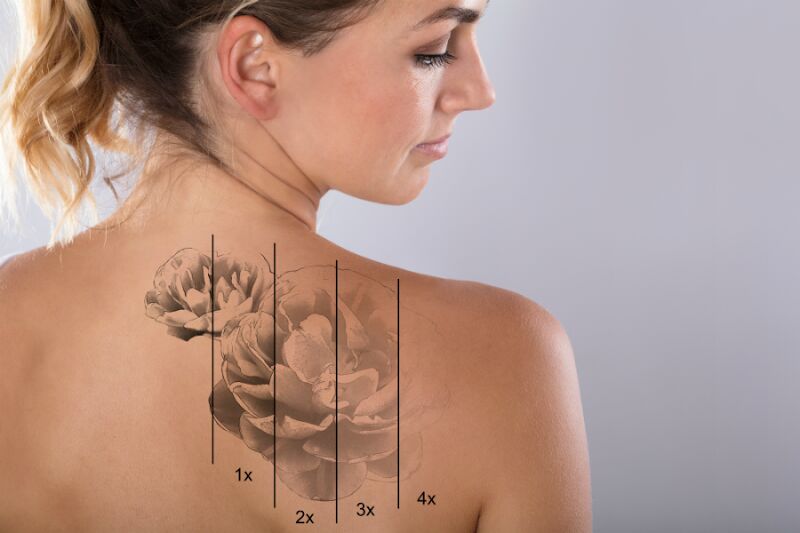 Foto van RemoveTattoo